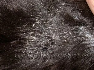 Close-up of a dog's coat showing heavy white scaling and flaking caused by sebaceous adenitis in Lacey