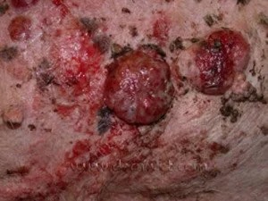 Close-up of a dog's skin showing raised ulcerated squamous cell carcinoma tumors in Lacey