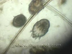 Microscopic view of a Sarcoptes scabiei mite from a dog skin scraping at a veterinary dermatology clinic in Lacey