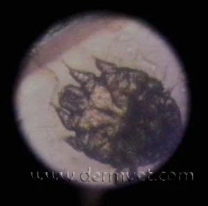 Microscopic image of a Sarcoptes scabiei mite responsible for sarcoptic mange in Lacey